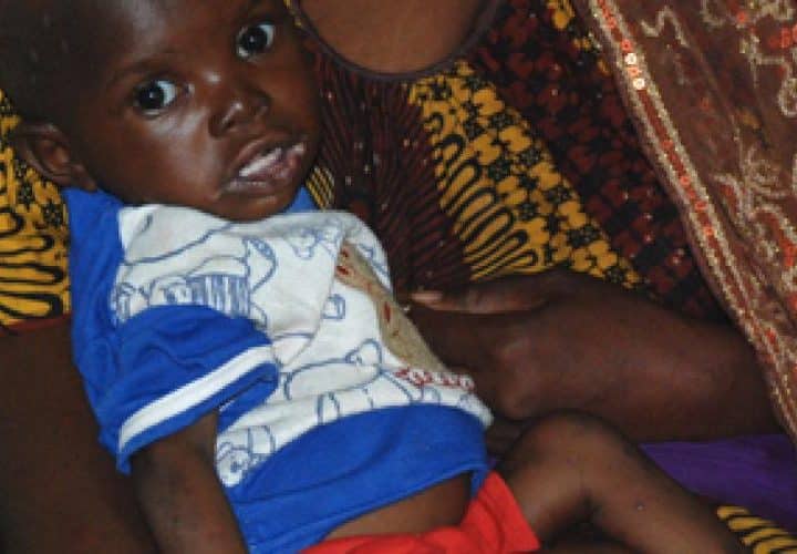 illustration de la malnutrition au Mali